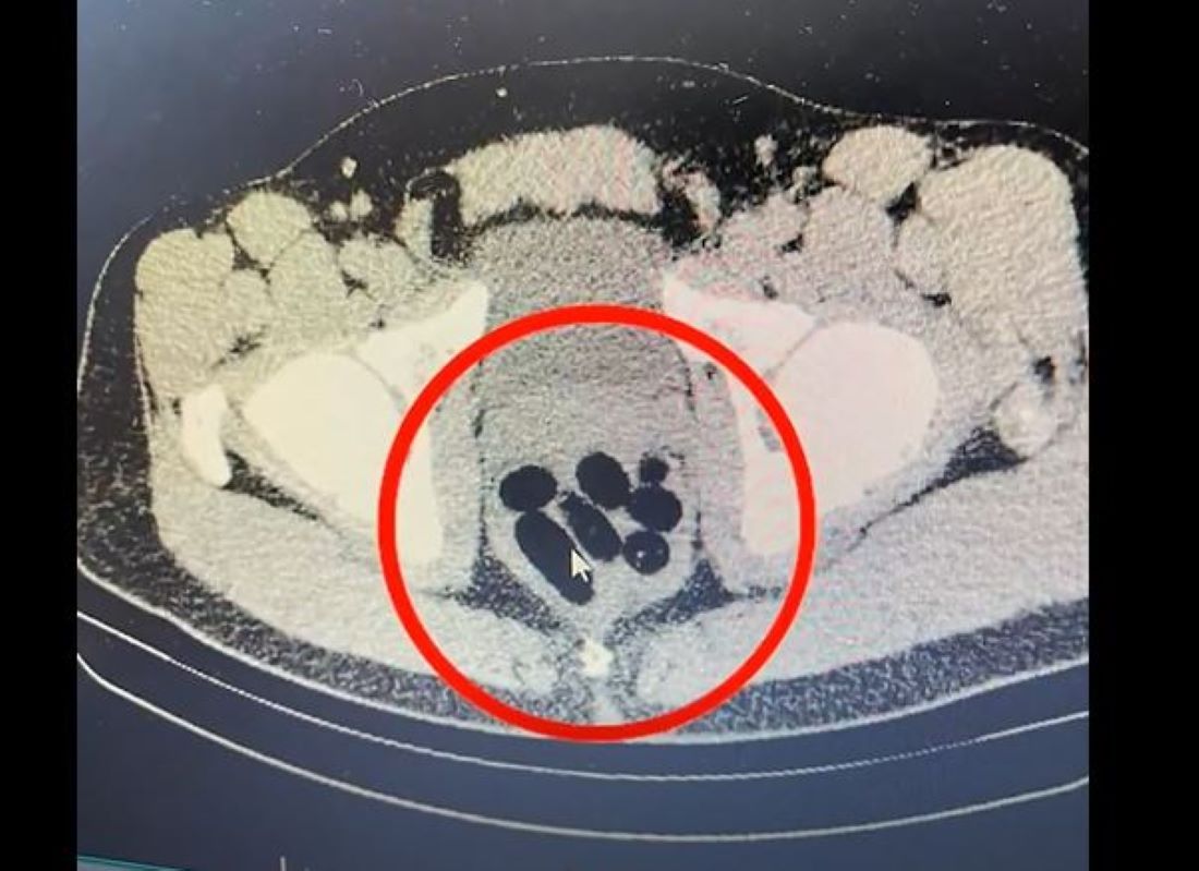 Kayseri Sondakika... Kayseri'de midesinde kapsül şeklinde 500 gram sentetik uyuşturucu bulunan şüpheli gözaltına alındı